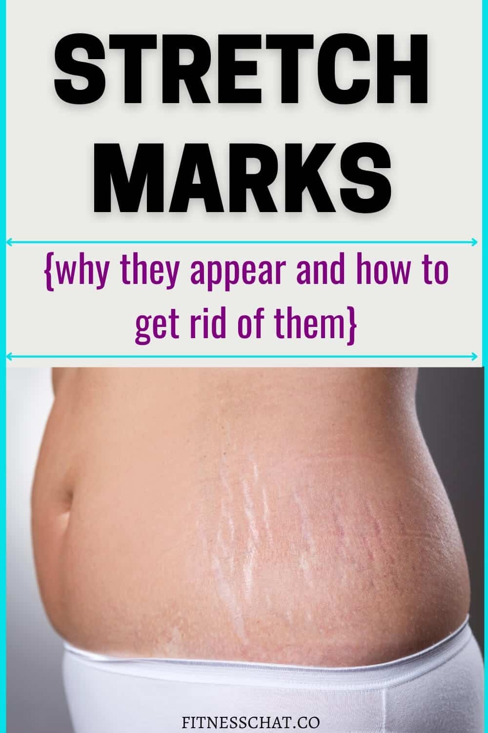 How To Remove Stretch Marks Fast 1 
